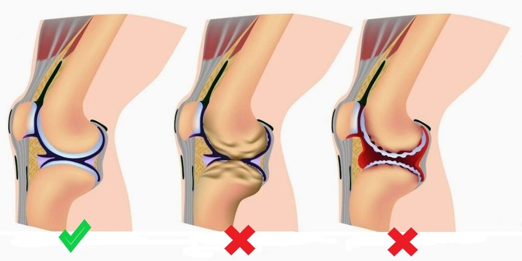 Depanten prevents the development of arthritis and arthrosis