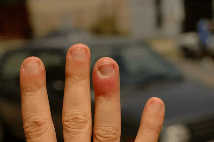 Periungual panaritium, causing pain in the joints of the fingers