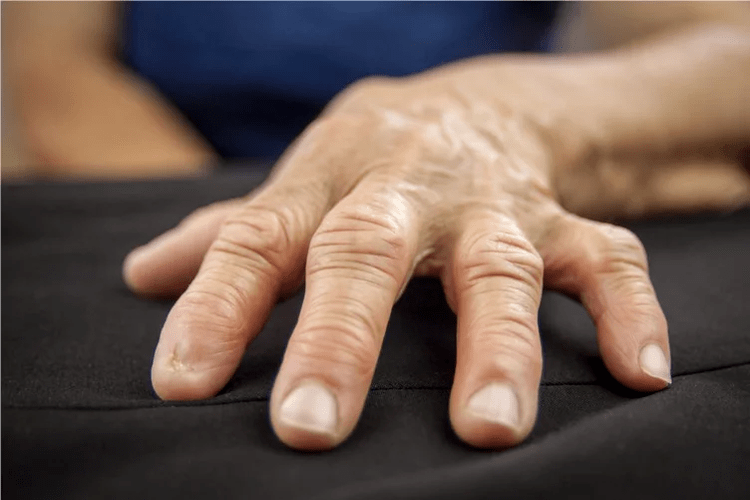 With gout, the knuckles of the fingers become warm to the touch, swollen, and painful. 