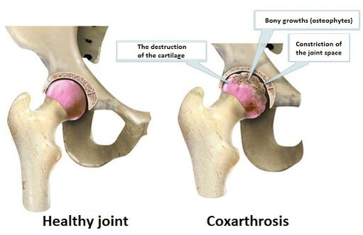 Healthy joint affected by coksartrosis joint