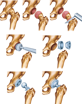 Installation of an endoprosthesis