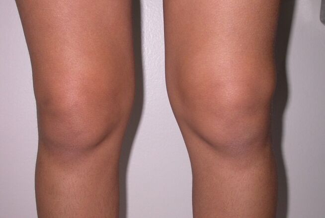 swelling of the knee joint with arthritis and arthrosis