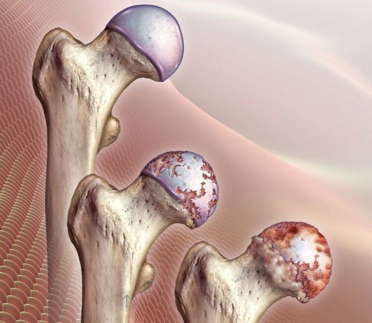 Arthrosis of the hip joint of varying degrees