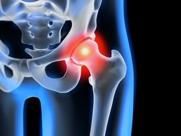 Arthrosis of the hip joint