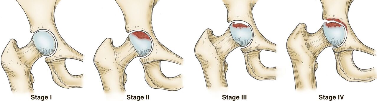 Degrees of arthrosis of the hip joint