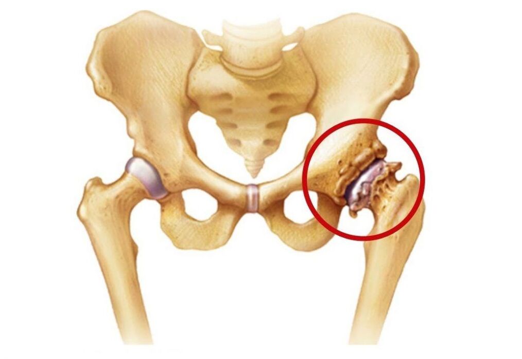 Hip joint affected by arthrosis