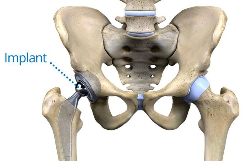 Total hip arthroplasty for arthrosis