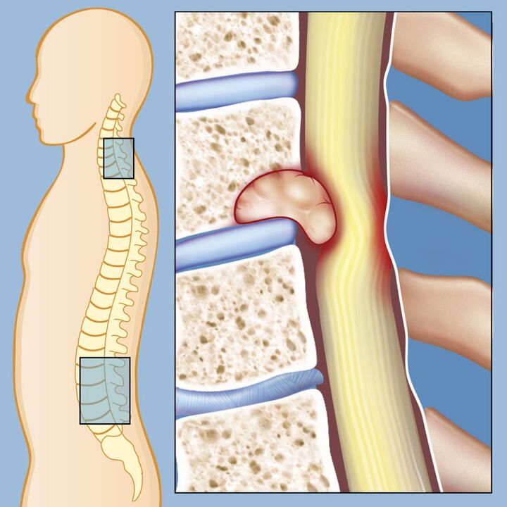 Malignant tumor as a cause of severe lumbar pain